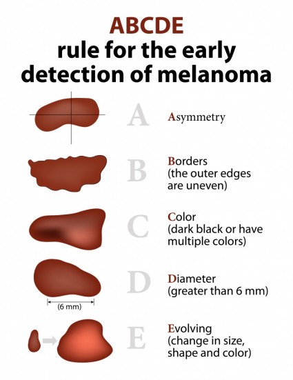 ABCD Rules of Skin Cancer - Moles and Melanoma